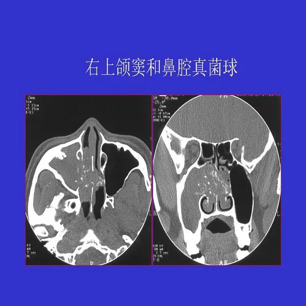 鼻窦炎ct图片详解片子图片