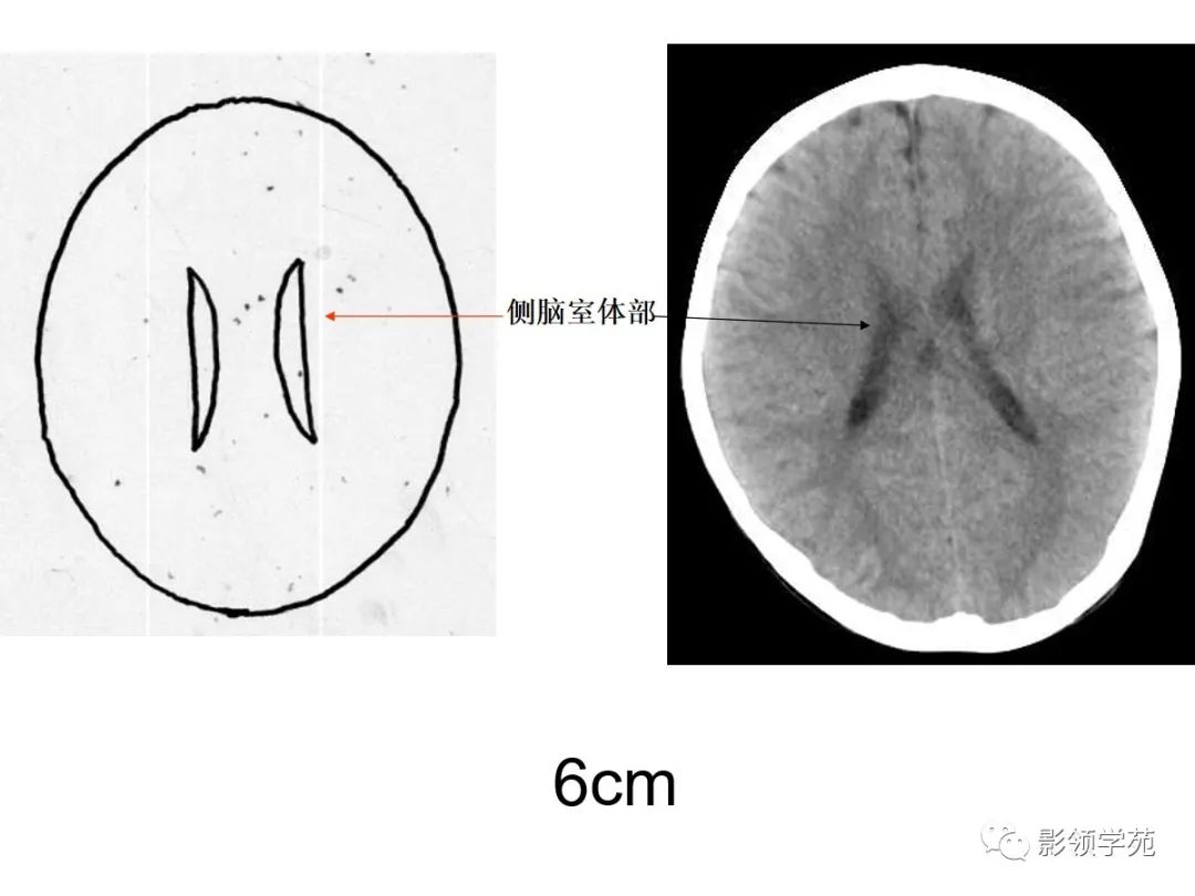 头颅ct扫描基线图解图片