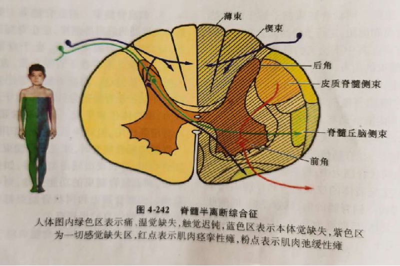 同側深感覺和精細觸覺缺失;③脊髓丘腦側束,病灶平面一兩個節段下對側