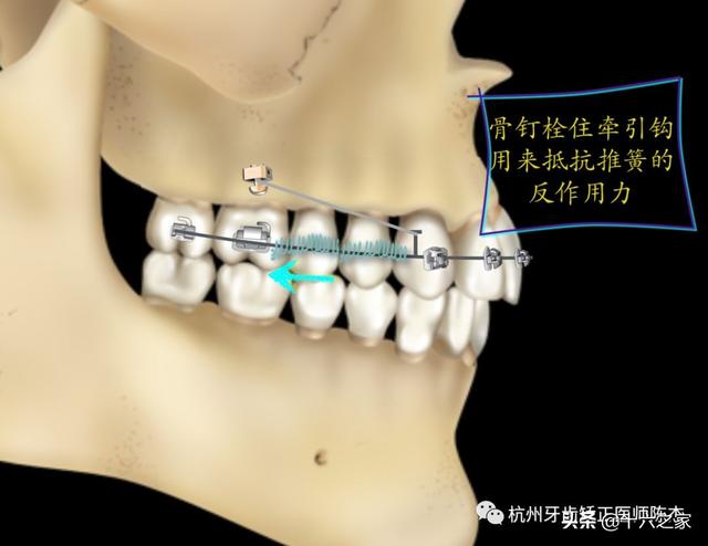 正畸臨床病例六簡單高效推磨牙向後技巧