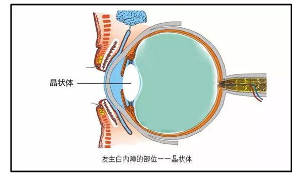 兒童也有可能患白內障,如先天性白內障.