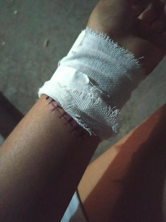 朋友们,手腕上有个刀疤刚缝过针,不敢让父母知道,过几天要回家了,怎样