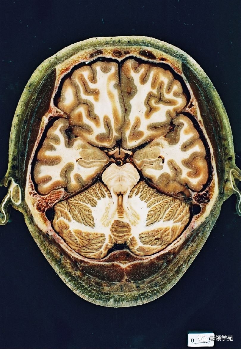 头部ct影像解剖_basal