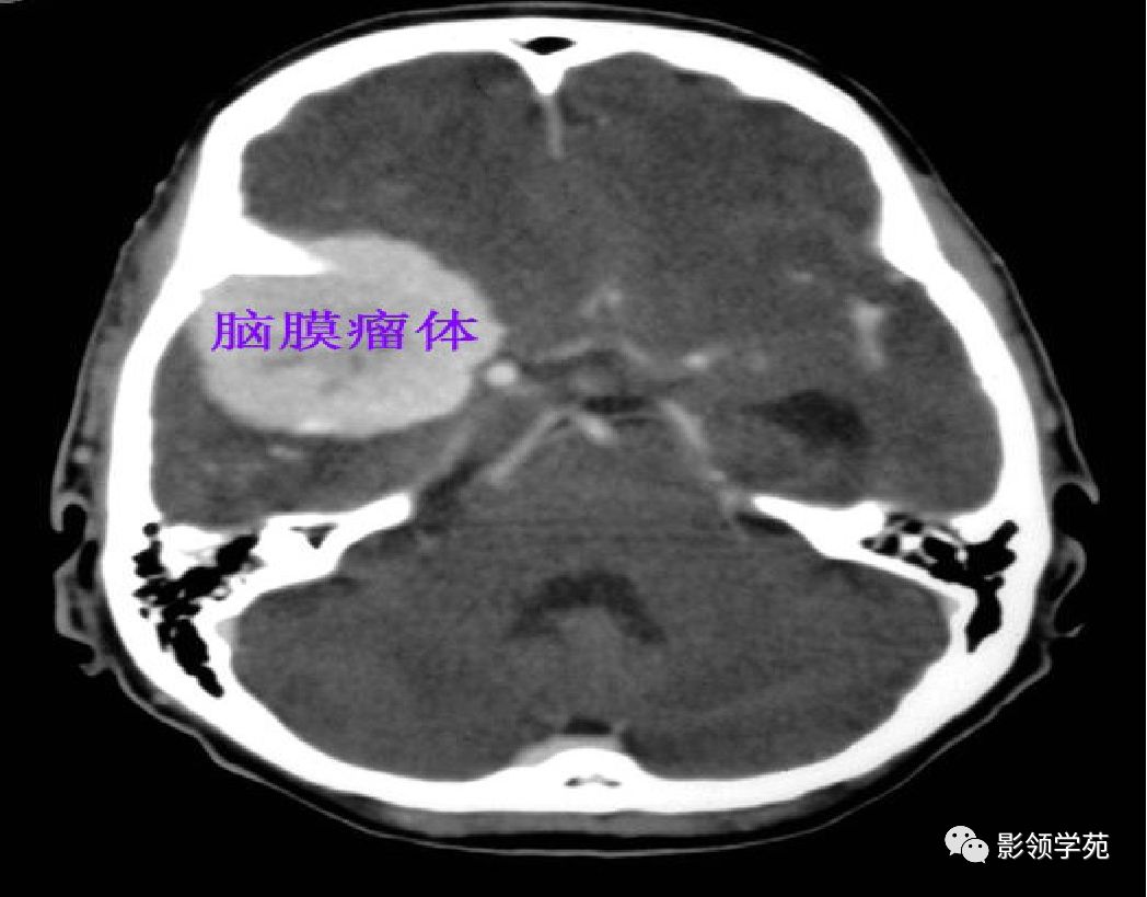 头部ct影像解剖_basal