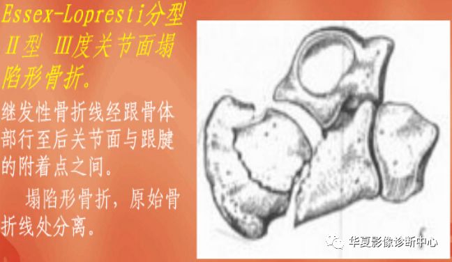 【影像基础】跟骨骨折影像学分型_移位