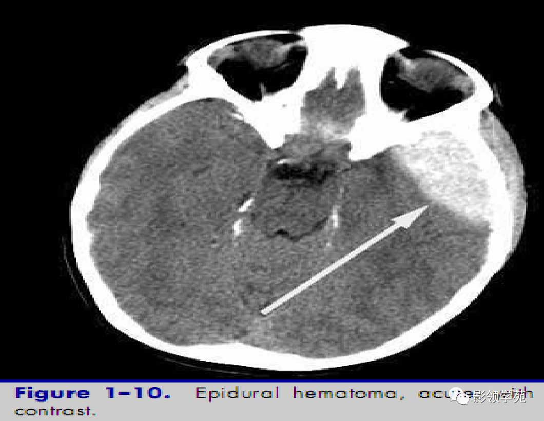 纹状体又分为:尾状核和豆状核,豆状核又可分为:壳核和苍白球.