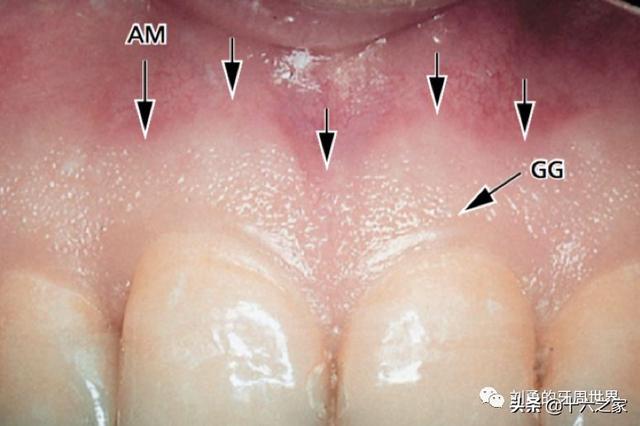 附着龈示意图图片
