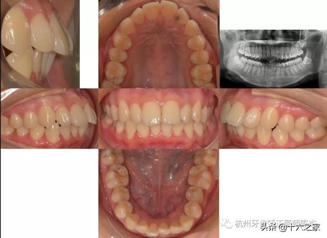 高腭弓和正常腭弓图片图片