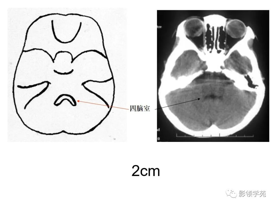 是大腦的中心灰質核團,包括杏仁核,紋狀體和屏狀核