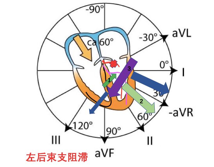 左后束支阻滞时,室间隔1除极异常,室间隔由右束支发出的电信号除极,右