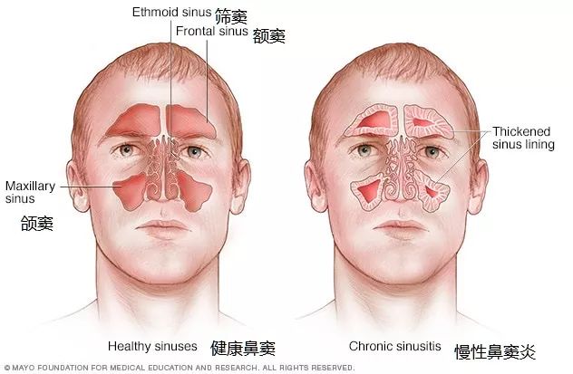 鼻炎做手術好嗎?有哪些風險是我們不知道的?