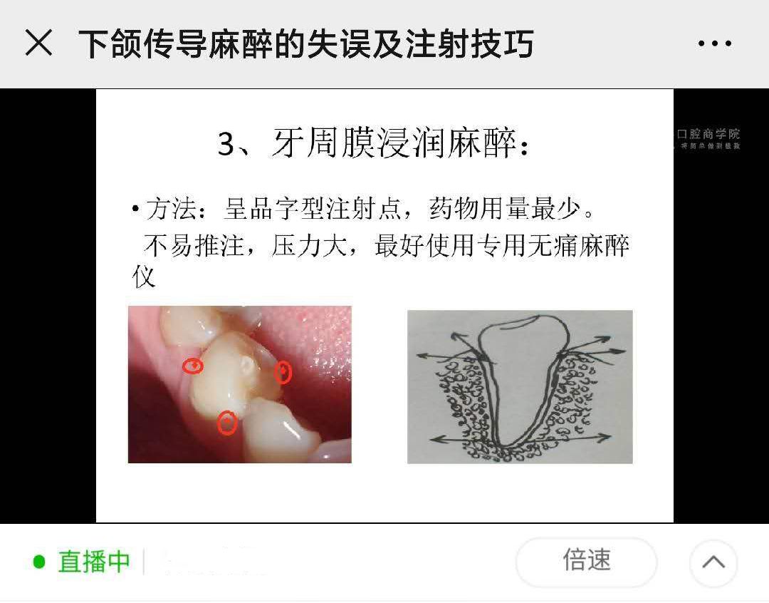 下颌阻滞麻醉 教程图片