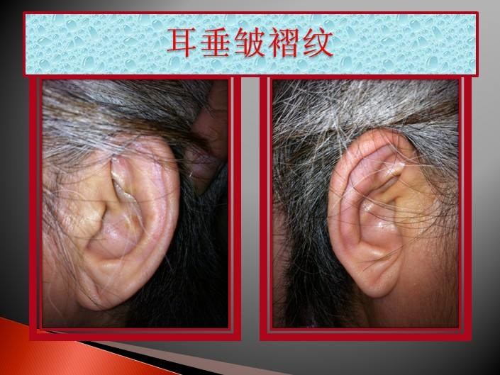 后下方,在耳廓后缘终止的一条呈45度的对角线,在医学上被称为frank征