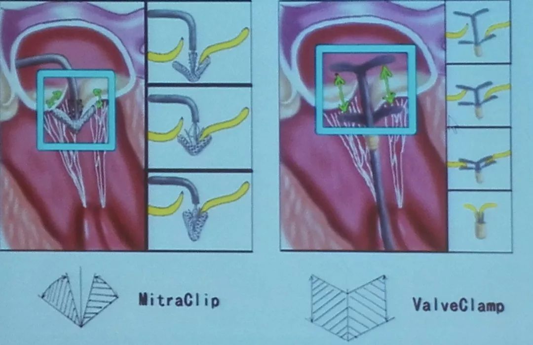 重磅二尖瓣修复术华南首例在广东省人民医院胜利完成