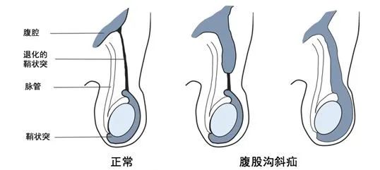 可复性疝气一般不会影响小孩正常生活,但是疝内容物一旦发生嵌顿(就是