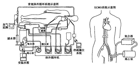 体外循环插管示意图图片