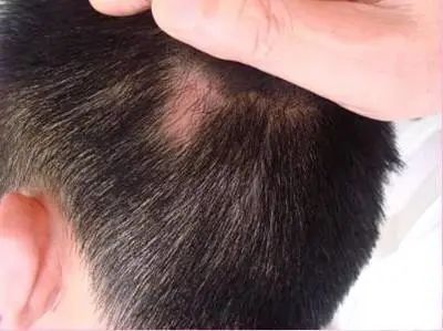 素问程医生 | 轻度斑秃,侧柏生姜来帮忙!