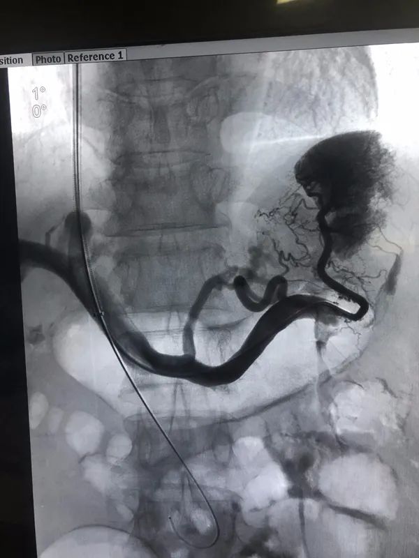 继往开来——柳州市工人医院血管外科独立完成两台高难度tipss术
