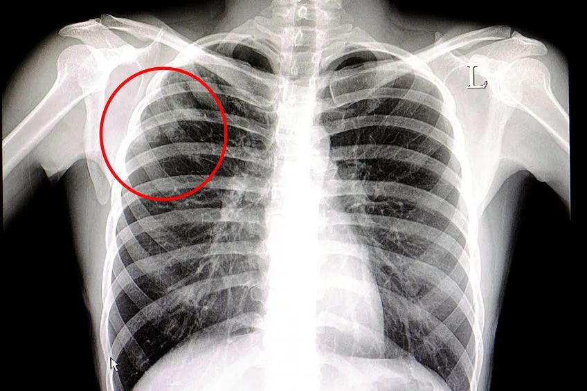没有症状怎么可能患肺结核呢部分肺结核可以没有症状