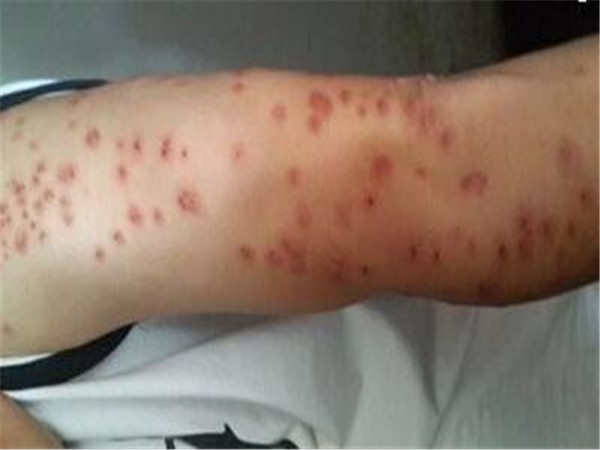 家里有臭虫怎么办,除臭虫 灭臭虫方法