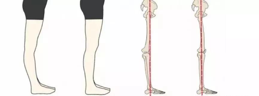 "膝过伸"也被称为"膝反张"或"膝反屈畸形",又称"锁膝"现象,即在行走或