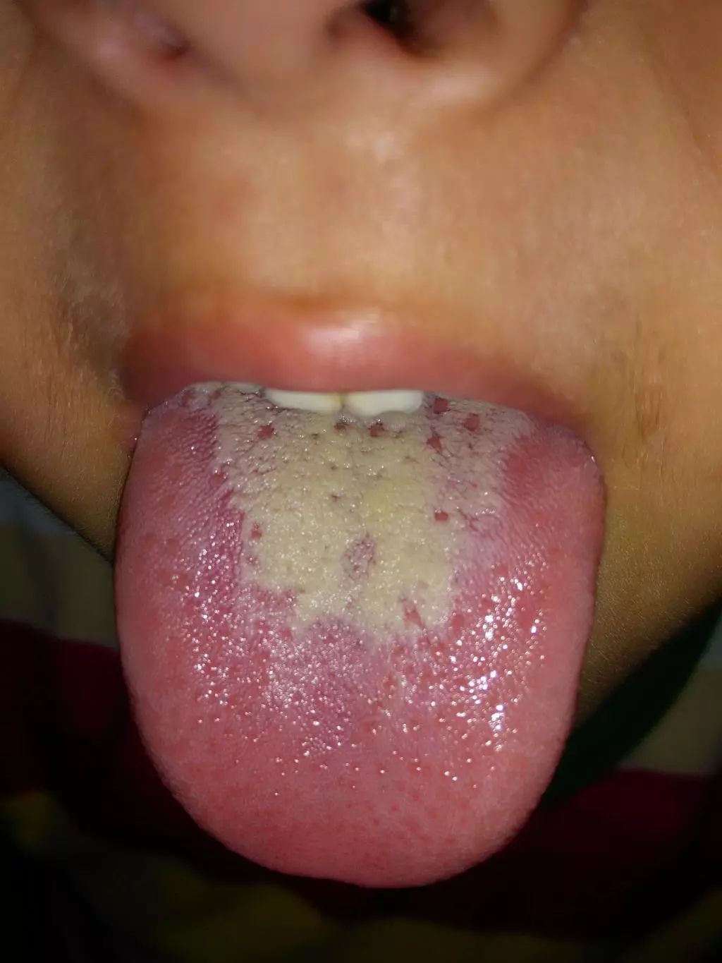 还有一种舌面上水很多,很光滑,比起那种腻的舌苔,它的流动性很大,拍照