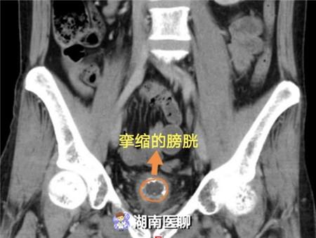 男子膀胱缩水1小时跑两趟厕所检查一看膀胱只有鸡蛋大小