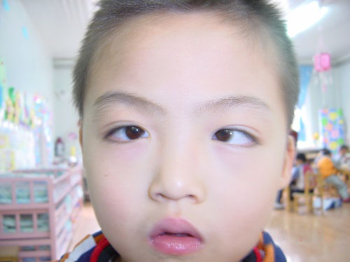 小孩眼睛出现斜视怎样矫正斜视的种类有哪些