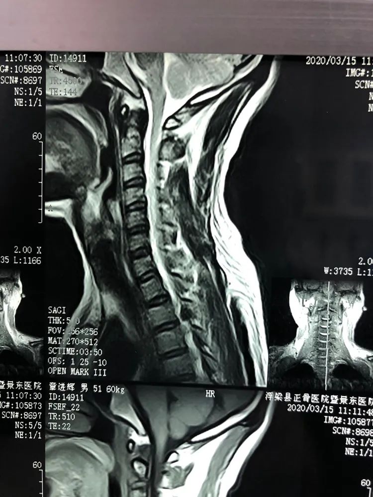 浮梁县正骨医院金陈孔镜治疗胸椎管狭窄有特效