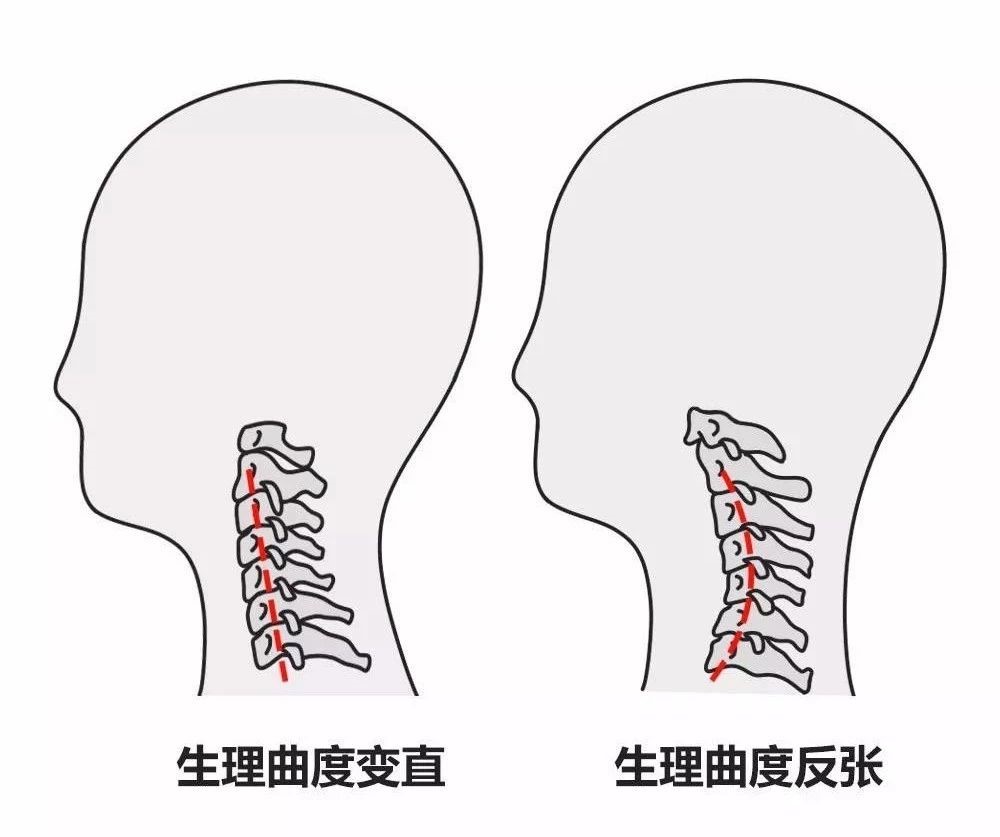 體檢報告上寫著頸椎生理曲度變直就意味著患上頸椎病了嗎