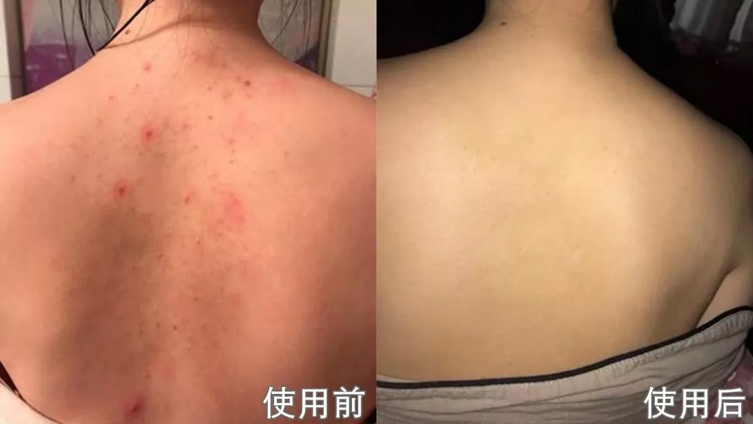 搓澡可以治鸡皮肤吗(搓澡可以改善鸡皮肤吗)