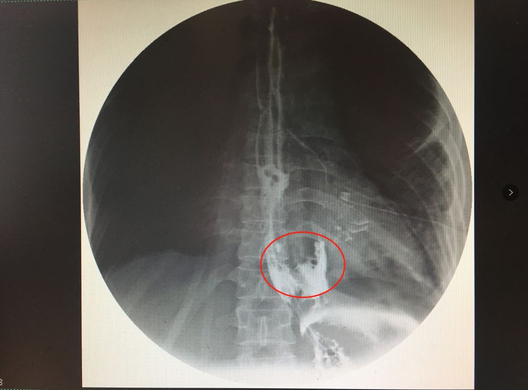 【临床前沿】肇庆一院这群医护人员太"硬核",把急危重食管破裂患者给