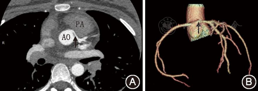 心血管疾病研究儿童左冠状动脉异常起源于右冠状窦伴动脉间行程四例