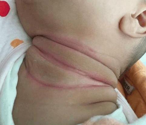 18个月的婴儿,脖子上有一圈像被绳子勒出的红痕, 宝妈干着急