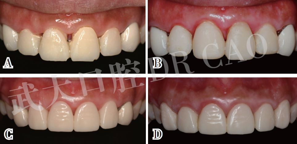 牙冠延长术的一般步骤及病例分享曹正国教授
