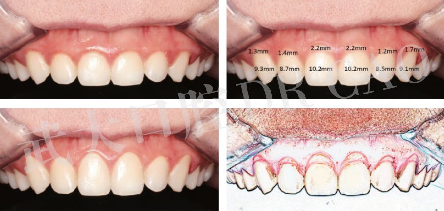 牙冠延长术的一般步骤及病例分享——曹正国教授