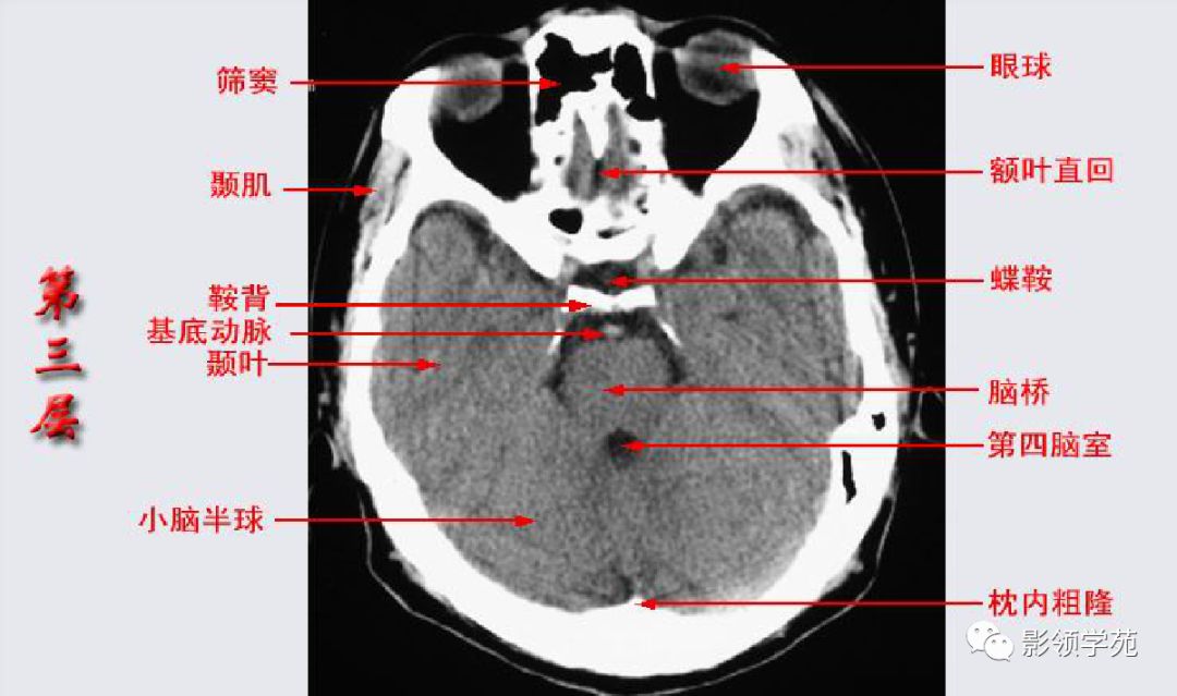 脑ct结构图解剖图高清图片
