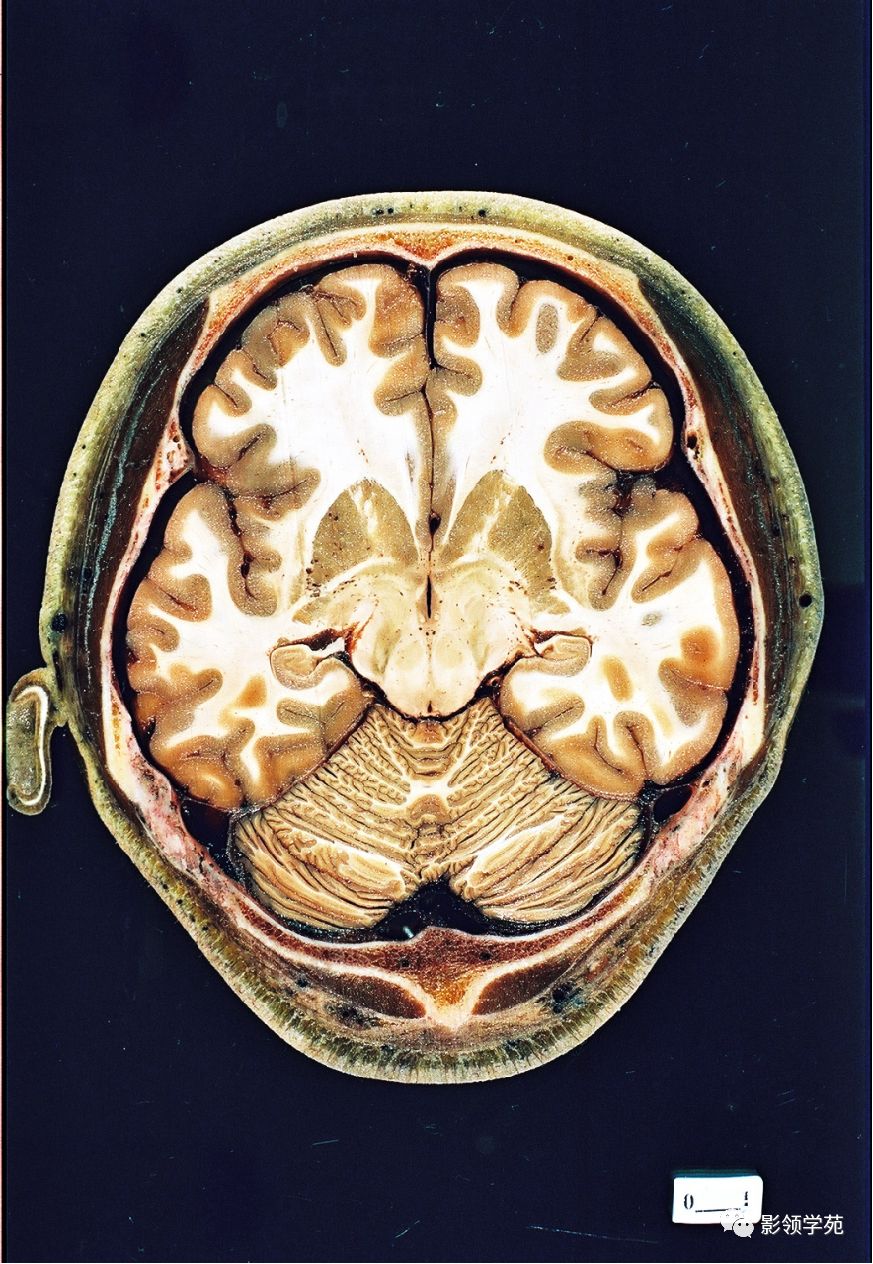 解剖&影像 | 頭部解剖及ct影像_董曉慧