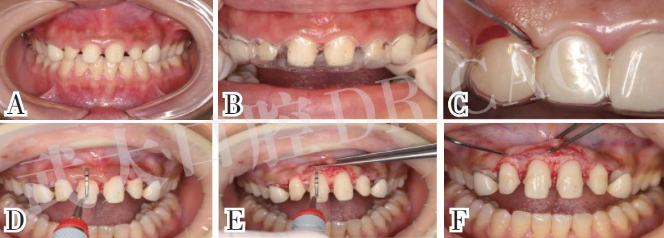 牙冠延长术的一般步骤及病例分享——曹正国教授