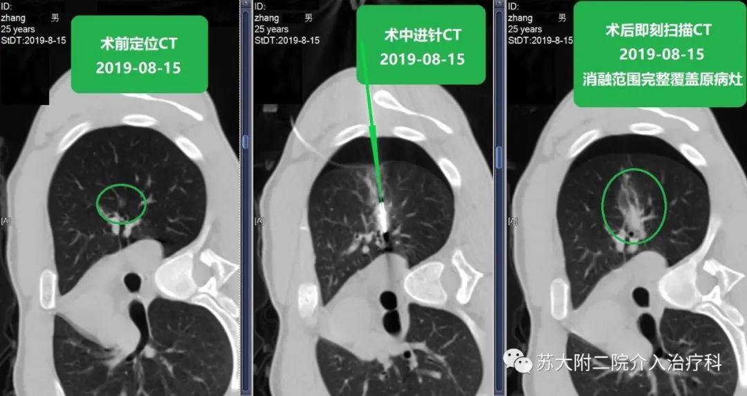 蘇大附二院靳勇醫生團隊病例分享第43期肺磨玻璃結節的消融