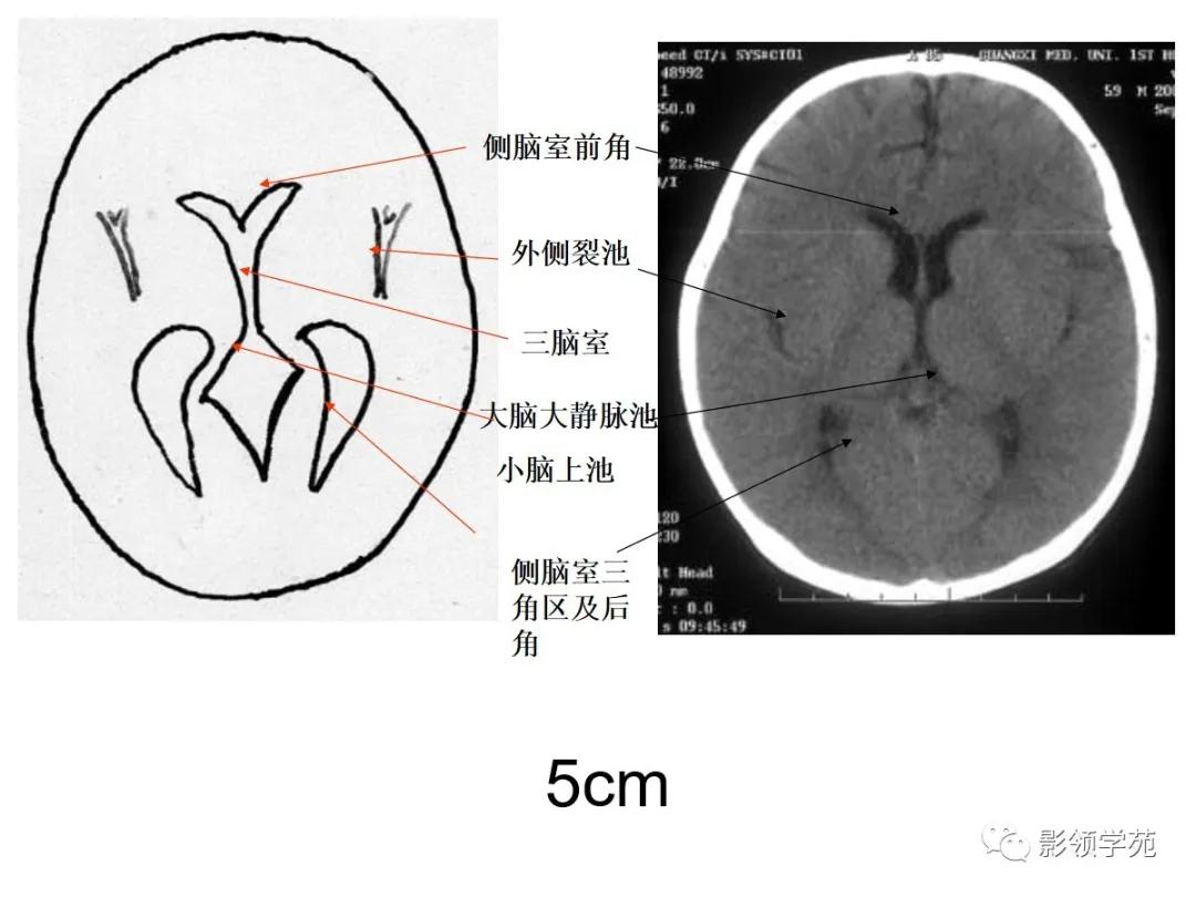 梨状肌ct解剖位置图图片