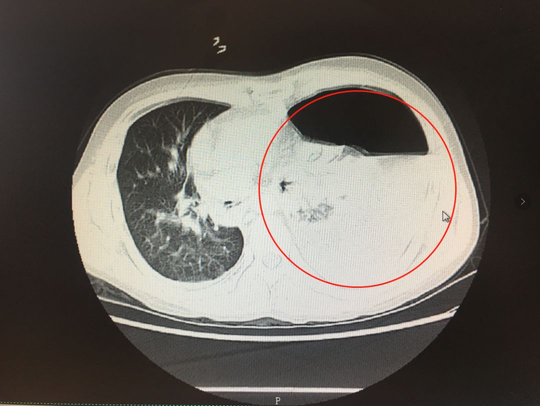 【临床前沿】肇庆一院这群医护人员太"硬核",把急危重食管破裂患者给