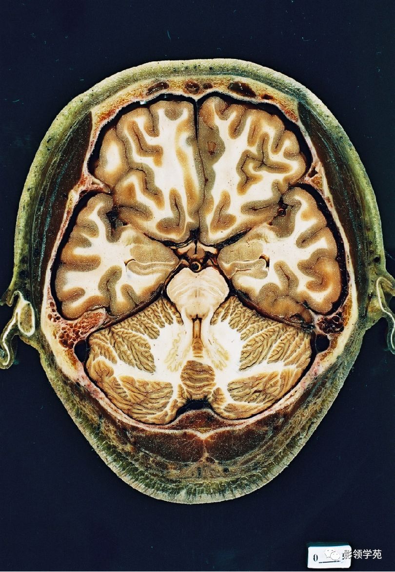 解剖&影像 | 頭部解剖及ct影像_董曉慧