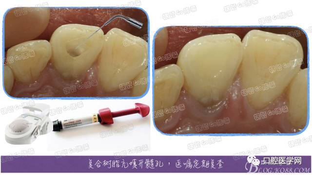 超聲乾淨髓腔內的封藥後樹脂充填,告知患者定期複診檢查~~~對於這樣的
