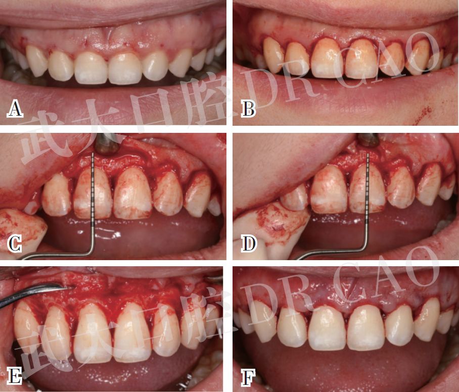 牙冠延长术的一般步骤及病例分享曹正国教授