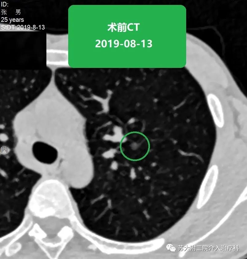 蘇大附二院靳勇醫生團隊病例分享第43期肺磨玻璃結節的消融