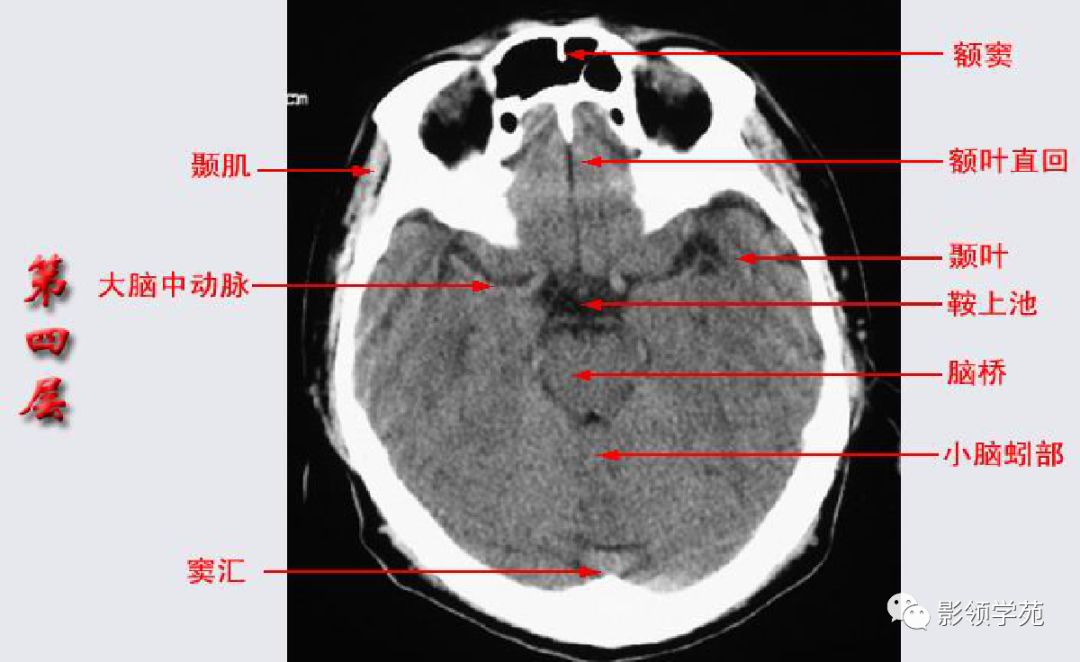 基底节区结构基底节(basal ganglia)(又称基底神经节)是指从胚胎端脑