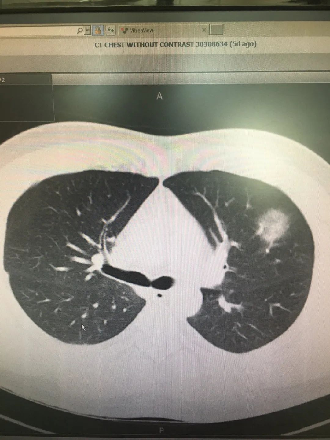 美国华裔确诊者出院,肺部感染照片首曝光!他最担心这个.