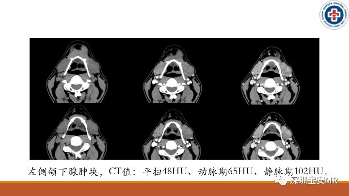 颌下腺 CT图片