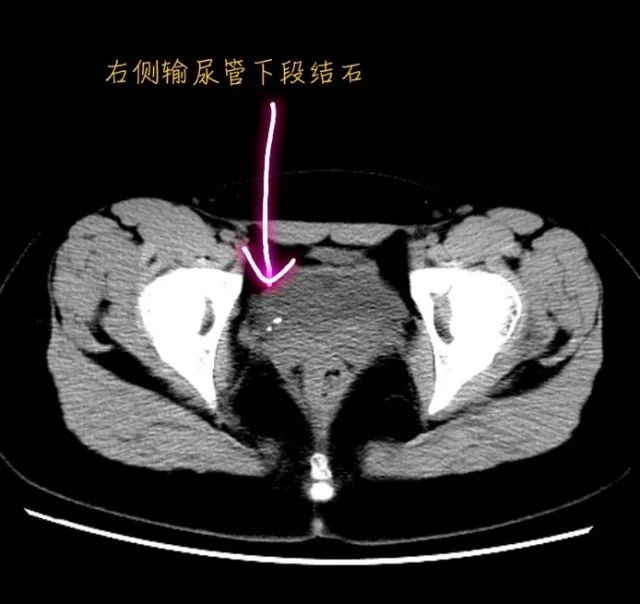 泌尿外科王鑫洪主任結合ct圖像判斷,小可右腎積水伴輸尿管結石,因為忍